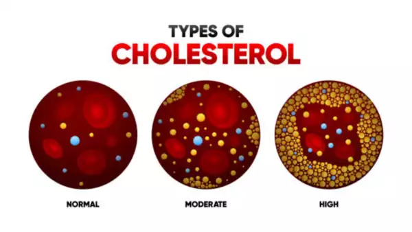 High Cholesterol