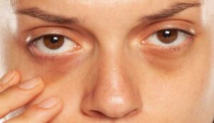 Dark Circles