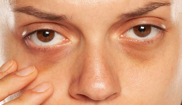 Dark Circles