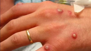 monkeypox