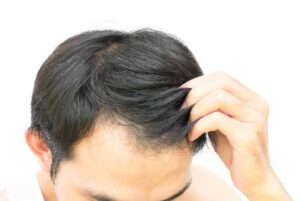 Hair Fall Remedies