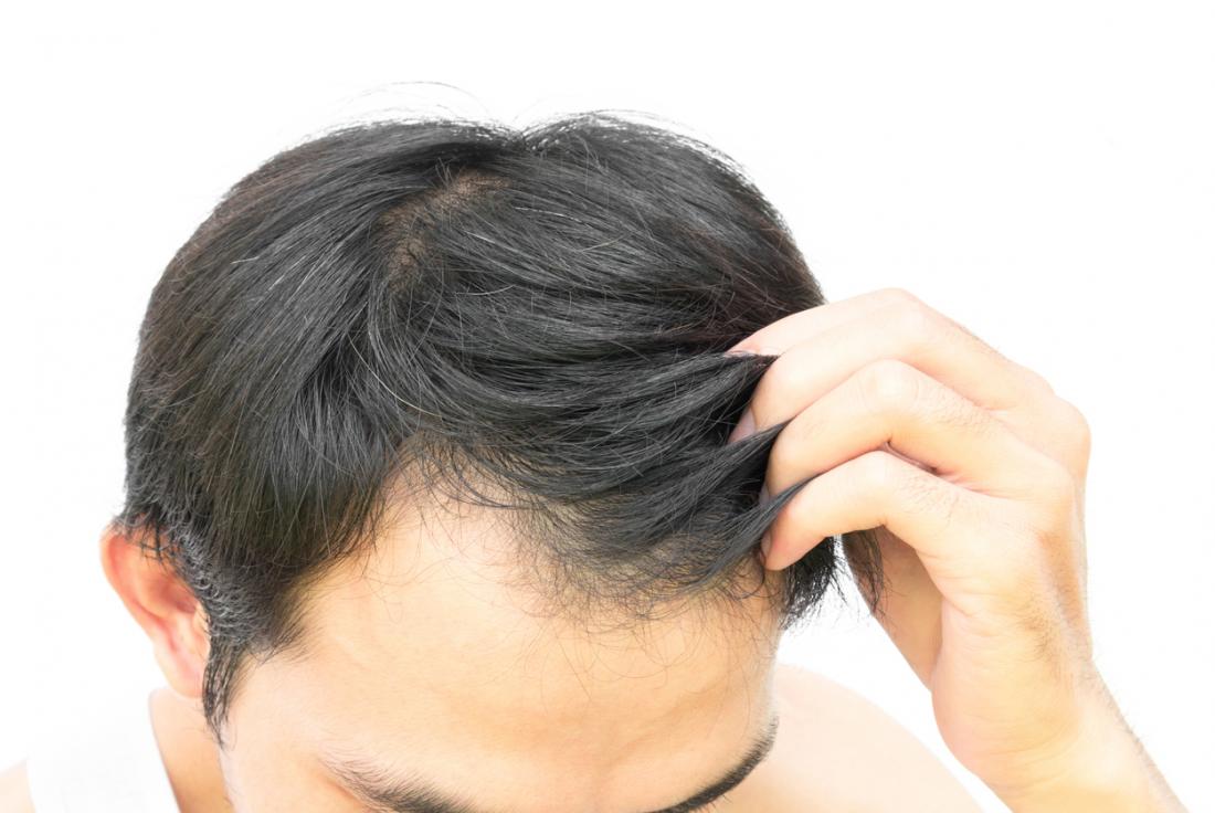 Hair Fall Remedies